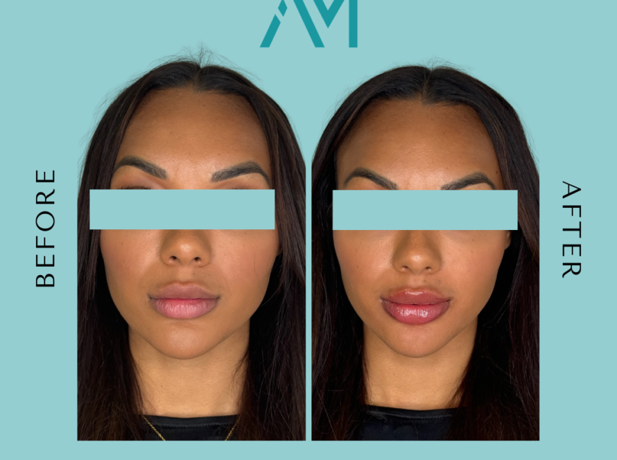 lip filler